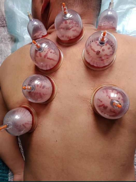 Делаю с выездом хиджама, шертпе, системы, уколы, перевязка,  вывод пос