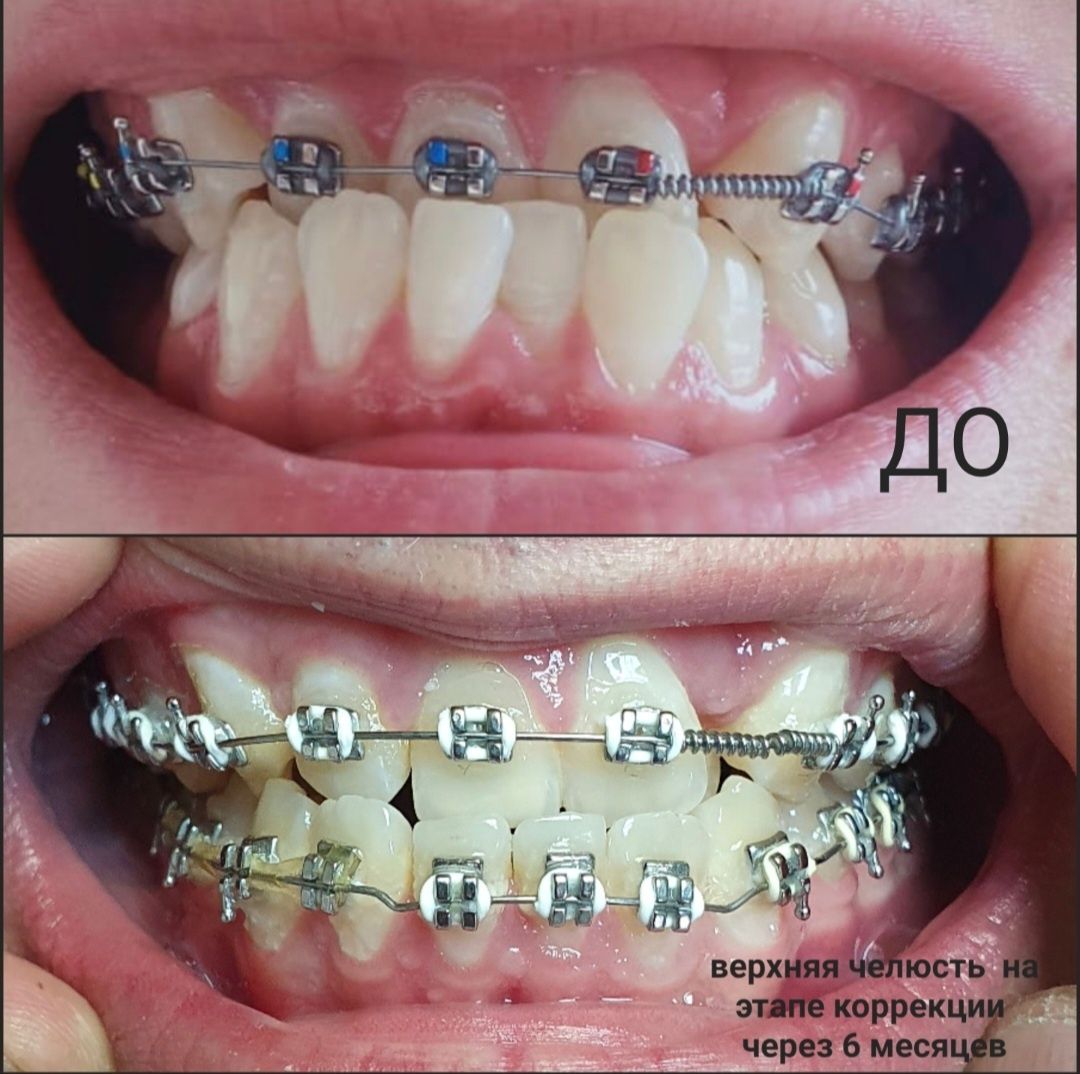 Брекет системы по АКЦИИ (ортодонтическое лечение)