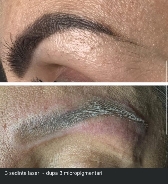 Stergere tatuaje cu laser nd:Yag