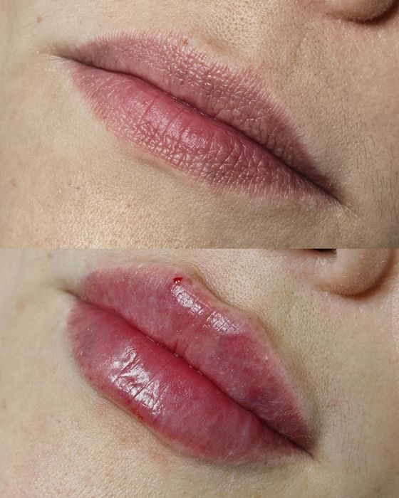 Увеличение губ, увлажнение губ, аугументация губ