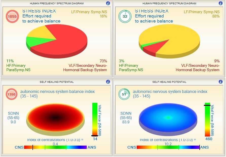 HRV Biofeedback si Biofeedback/Biorezonanta SCIO