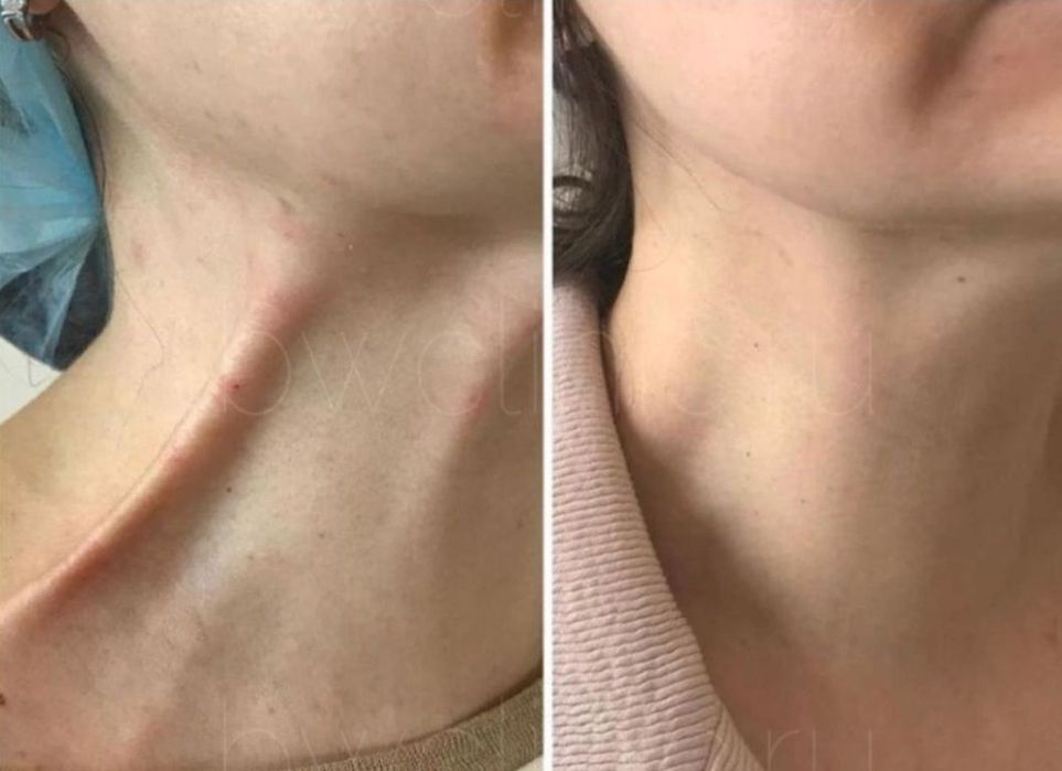 Лифтинг нефертити. Шея