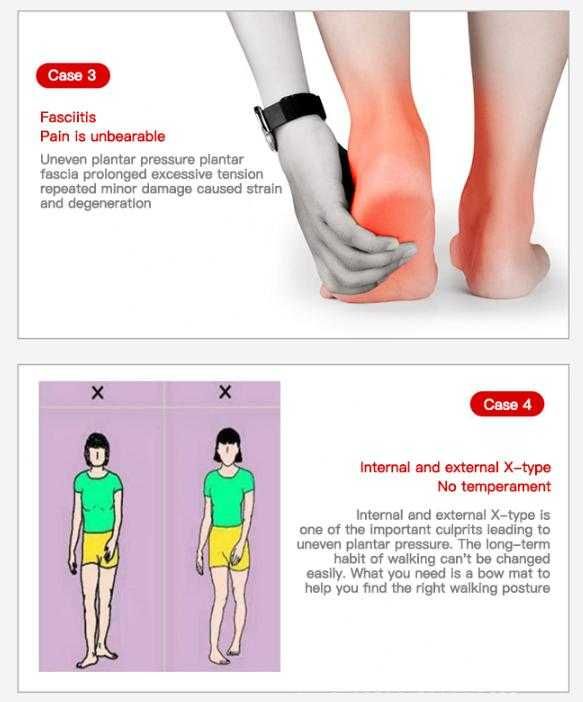 Ортопедични Стелки О-образна Форма на Краката OX Крак Дюстабан Стъпало