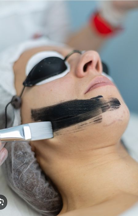 Карбоновый пилинг лица.