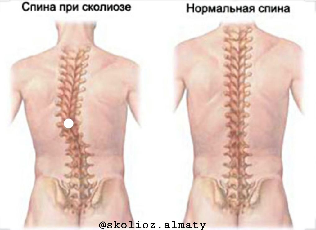 Лечение  сколиоз, грыжи позвоночника, протрузии, остеохондроза.