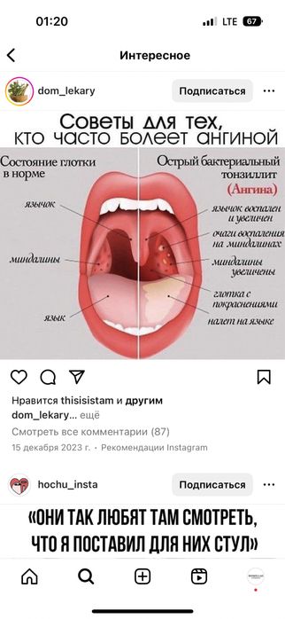 Ангина Тонзилит синусит 10тыс лечение
