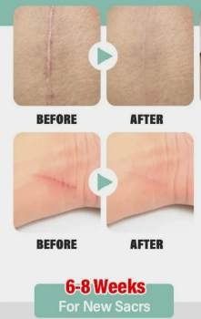 Силиконовый пластырь для лечения шрамов и ожогов. Размер 4см на 15 см