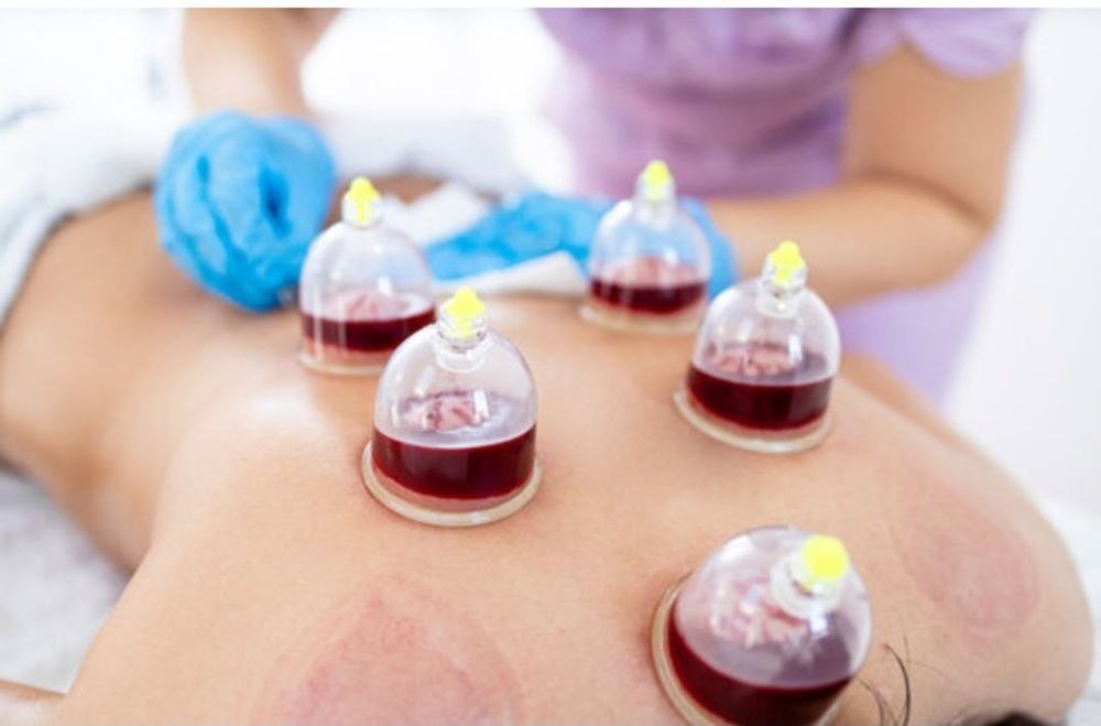 Хиджама и зулук Hijama zuluk davolash