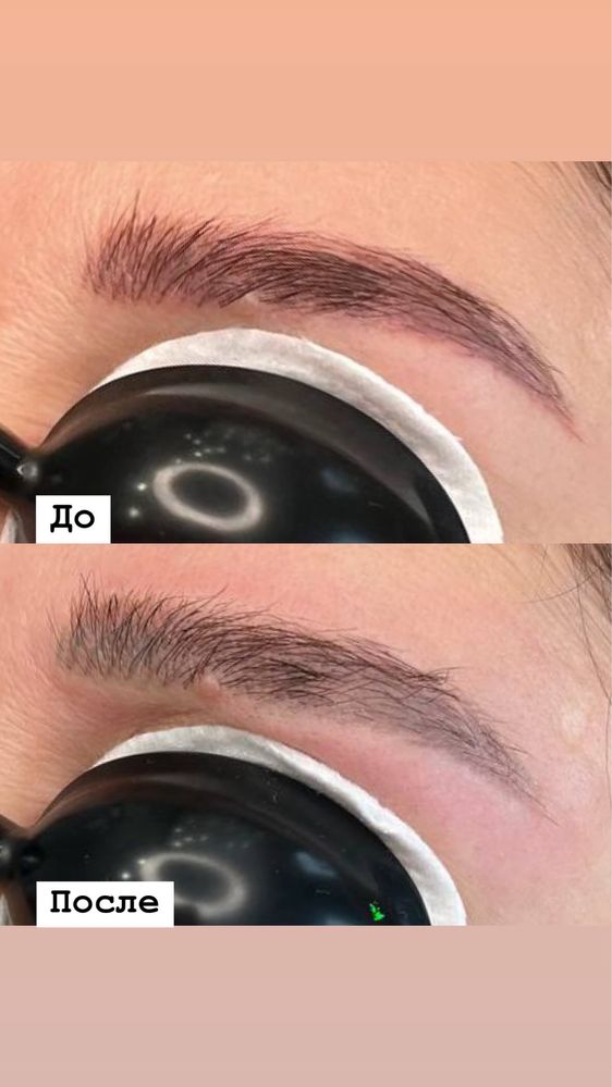 Лазерное удаление татуажа