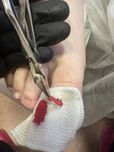Чирчик Подолог Вросшие ногти Трещины Мазоли Натоптыши