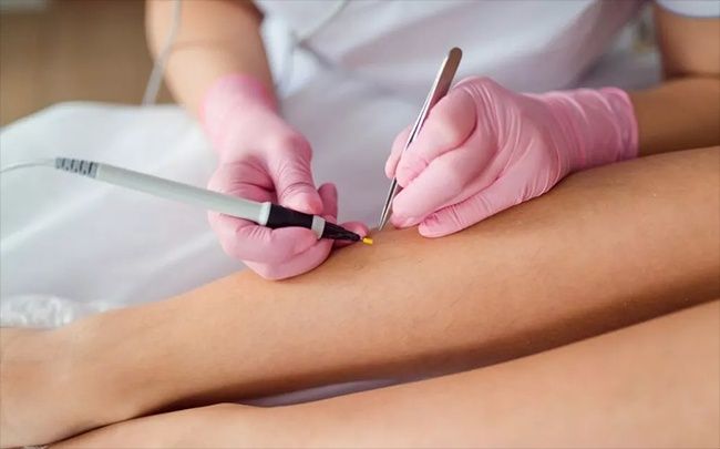 Электроэпиляция в Самарканде