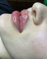 Увеличение губ, ботокс full face, мезотерапия