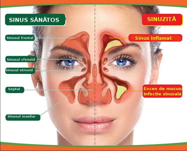 Dispozitiv de terapie cu infraroșu pentru tratamentul rinitei alergice