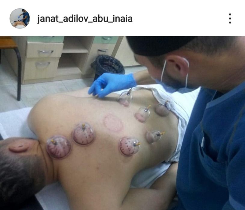 Хиджама Кровопускание