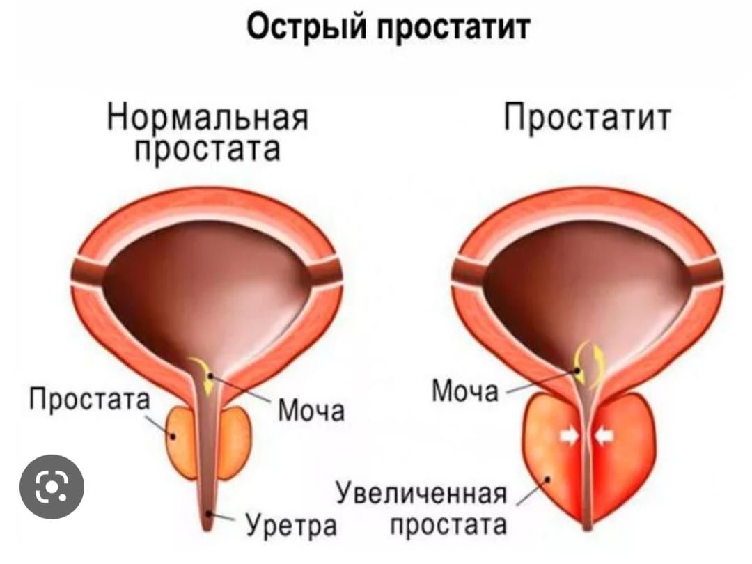 Урологически массаж на простатит