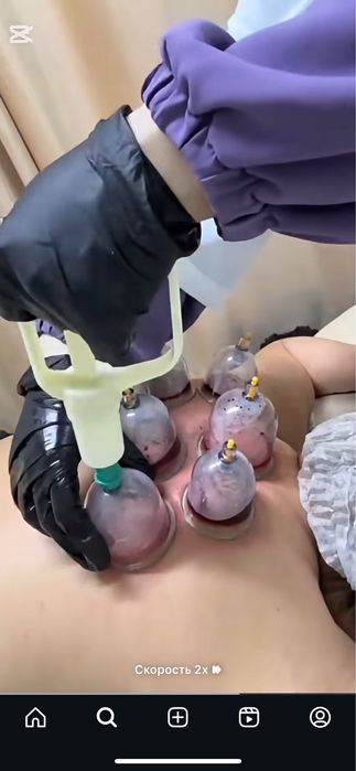 Хиджама с выездом на дом