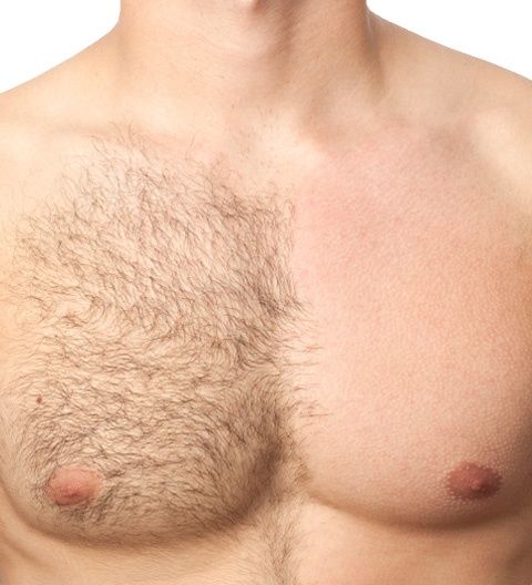 Epilare definitivă bărbați – tratament profesional cu laser
