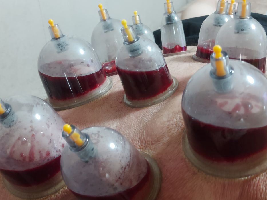 Хиджама и гирудотерапия с выездом