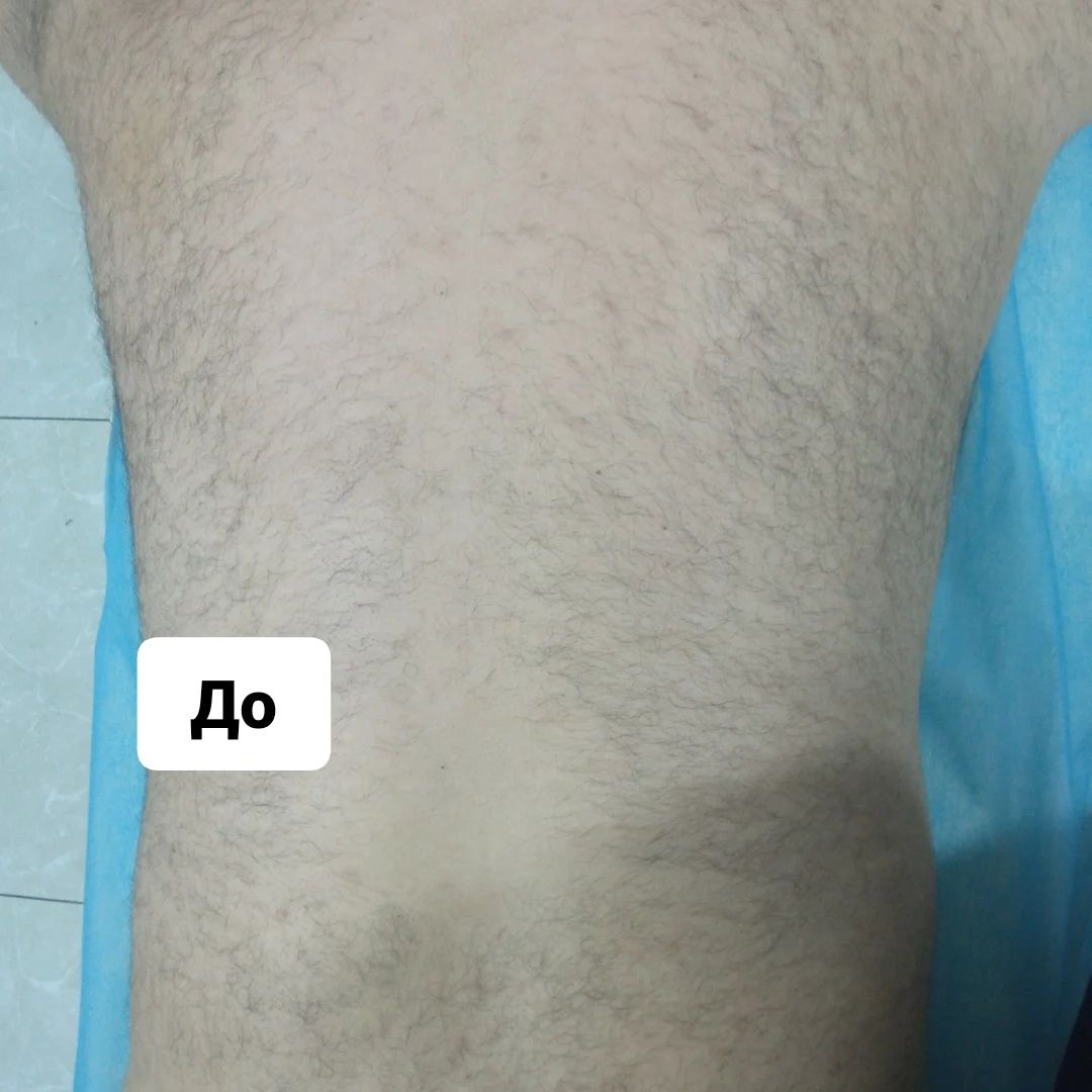 Депиляция мужская и женская