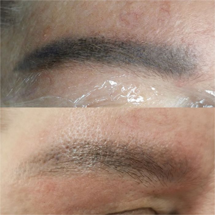 Удаление старого татуажа