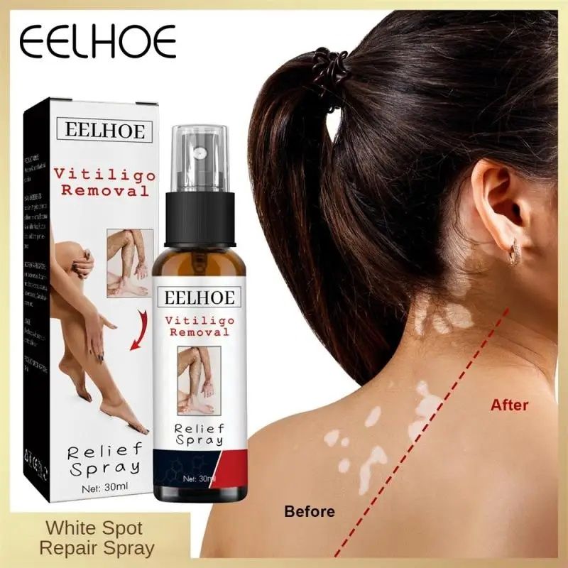 Spray Pentru pete Vitiligo 30ml, Oferta limitata