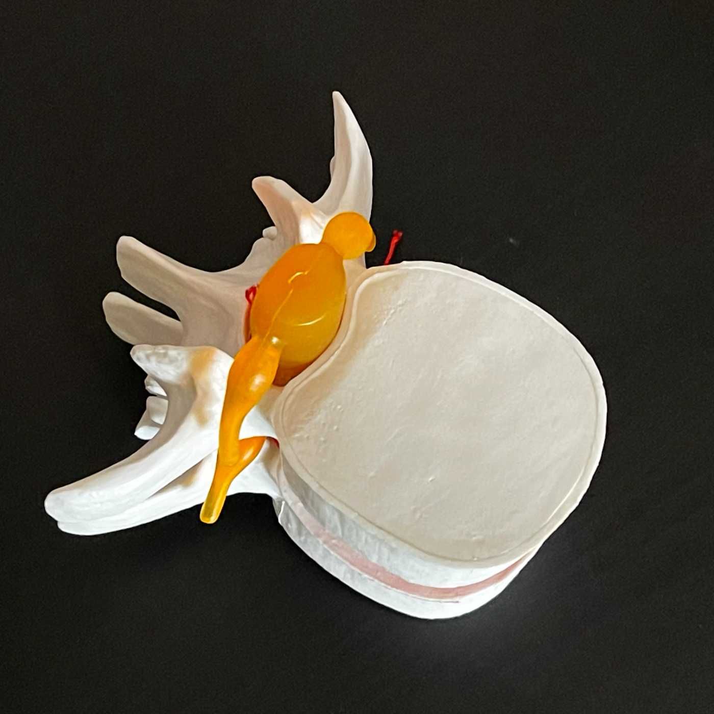 Model de hernie de disc lombară anatomică umană