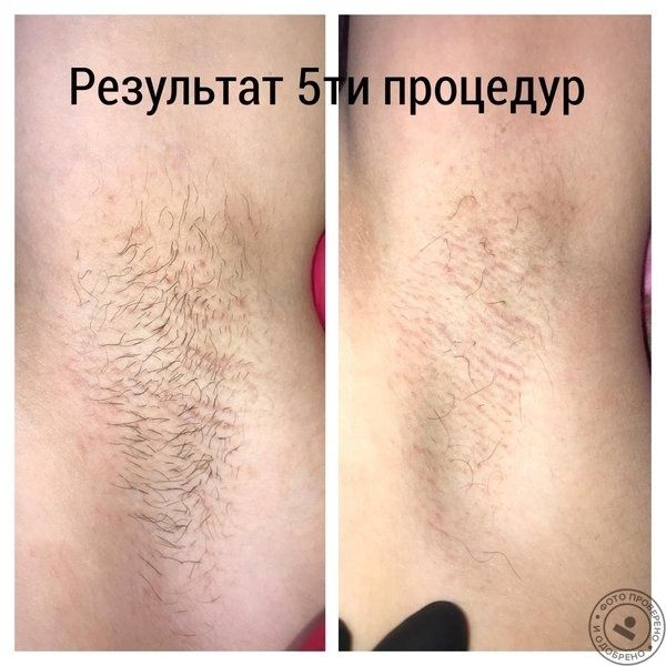 Электроэпиляция в Самарканде