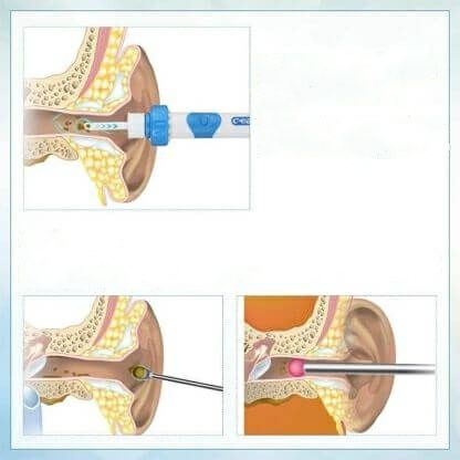 Професионален уред премахва ушната кал и лесно абсорбира мръсотията