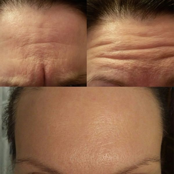 Ботокс Кореи, Япония.