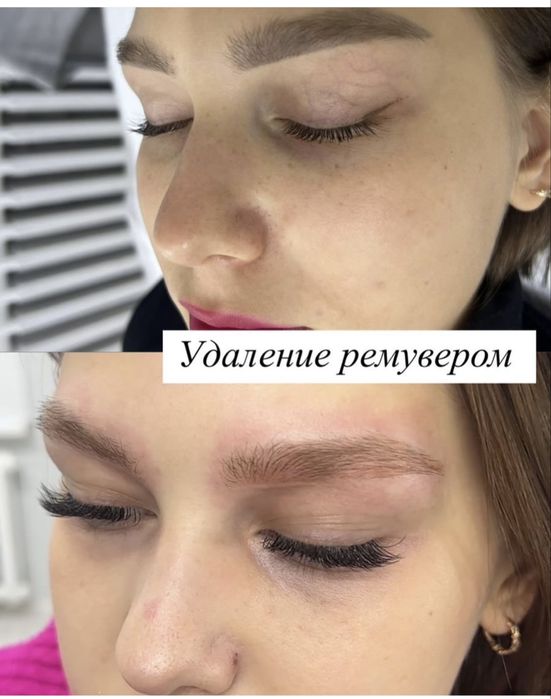 Модели на удаление татуажа ремувером