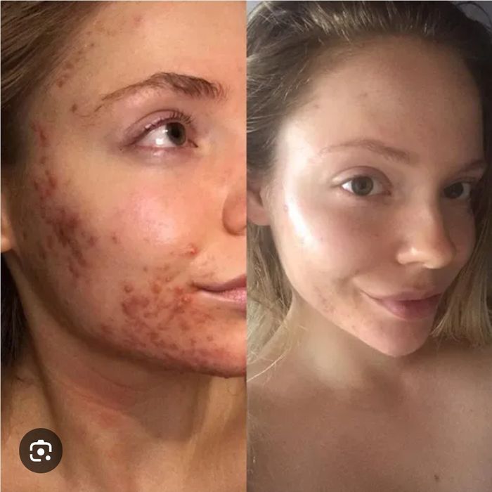 Угри,акне.прыши личение.