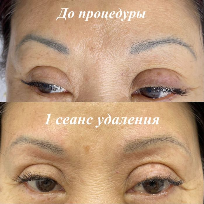 Перманентный макияж, удаление татуажа и тату