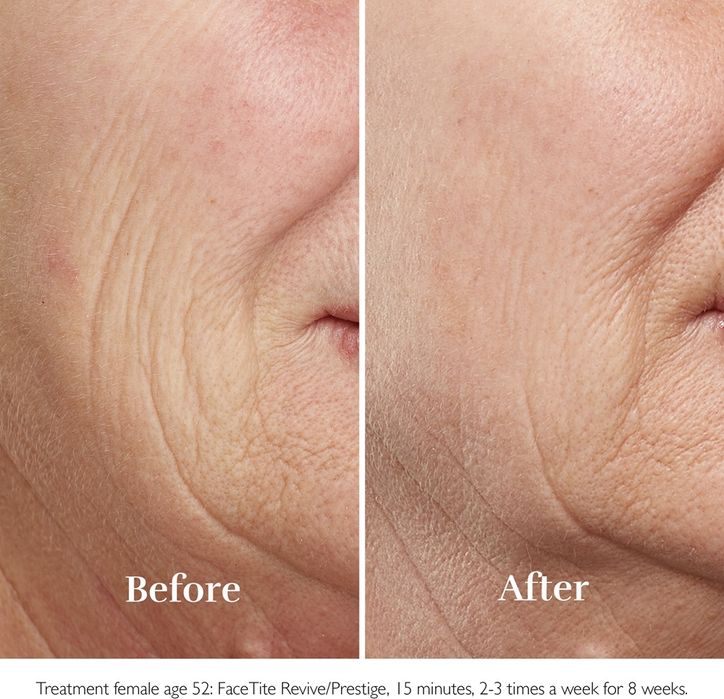 SILK'N FaceTite HT Уред за изглаждане на бръчките и стягане на кожата