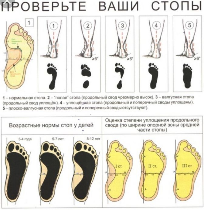 Ортопедик стелка. Яссиоёклик учун мослама