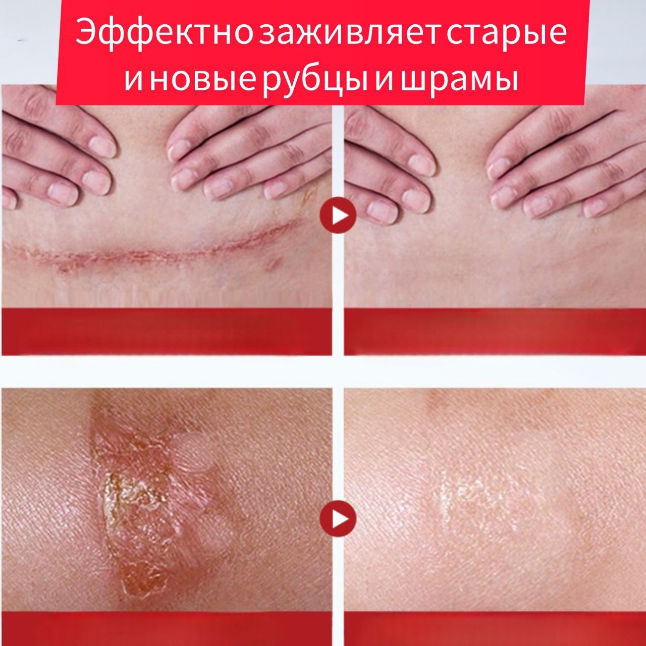 Крем от шрамов и Рубцов