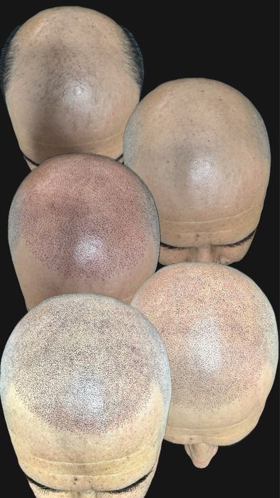 Micropigmentare Scalp și barba Bucuresti SMP chelie implant transplant