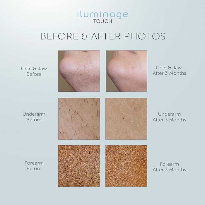 Iluminage TOUCH epilare permanenta IPL
