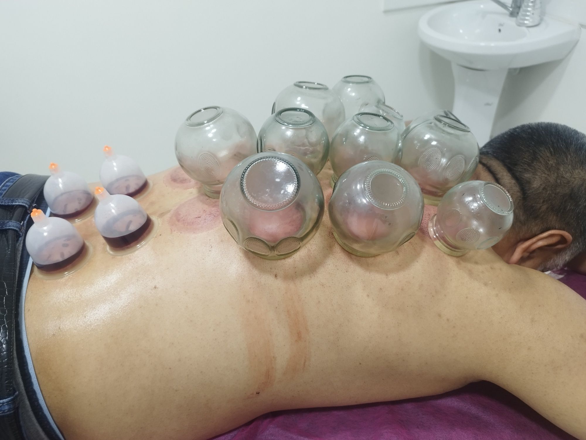 Hijoma bilan davolash hijoma va zuluk muolajasi klinik sharoita