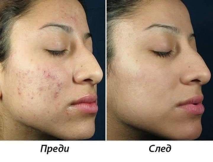 Лечение на акне/пъпки/ проблемна кожа с аквасорс