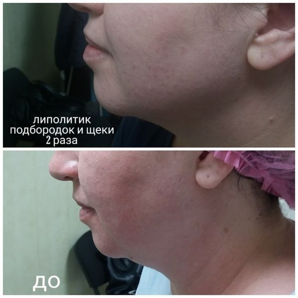Липолитики тело, живот, бока, руки, ноги