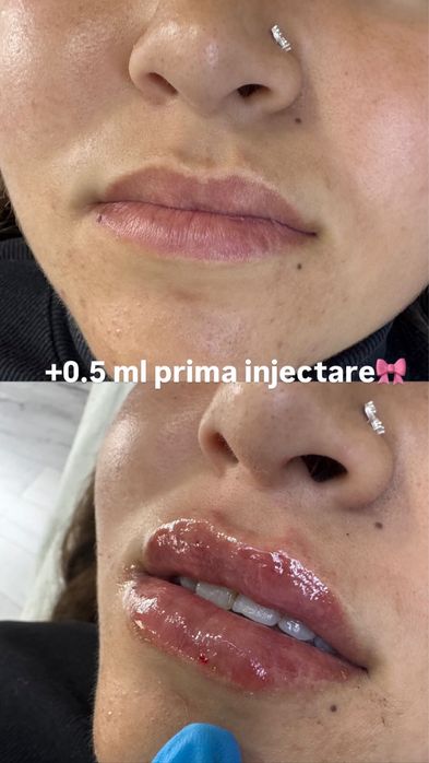 Augmentare buze,menton,riduri