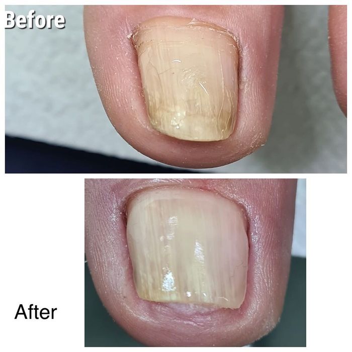 Pedichiura medicala.Instrumentar sterilizat in autoclav.Liftup gel
