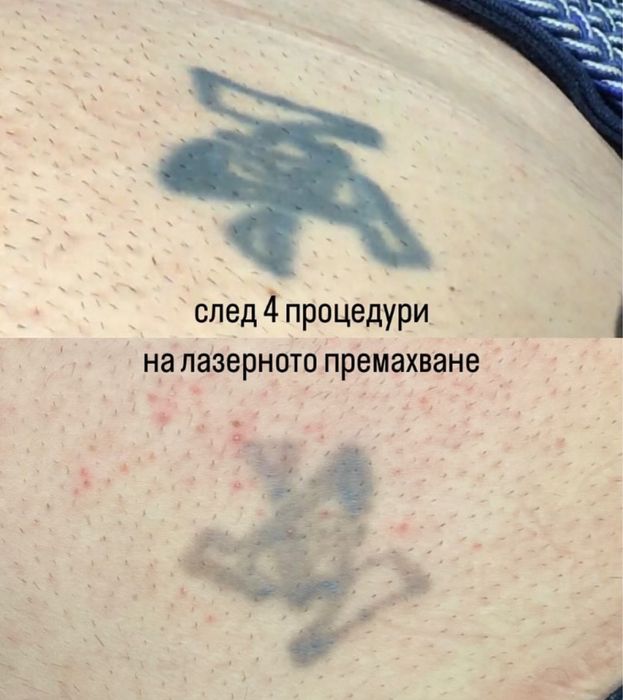 Лазер за премахване на татуировки и грим – наем