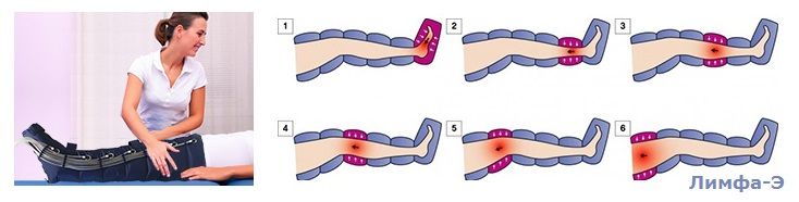 Прессотерапия. Лимфодренаж