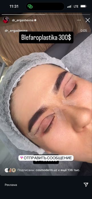 50% chegirmada blefaroplastika