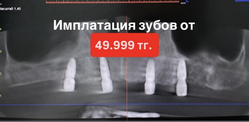Импланты от 49.999.