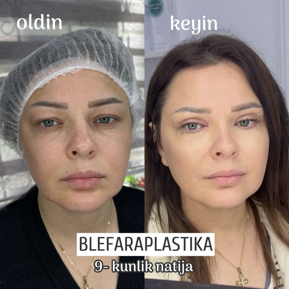 Skidkada Kosmetologik muolajalar ulgurib qoling faqat shu oy