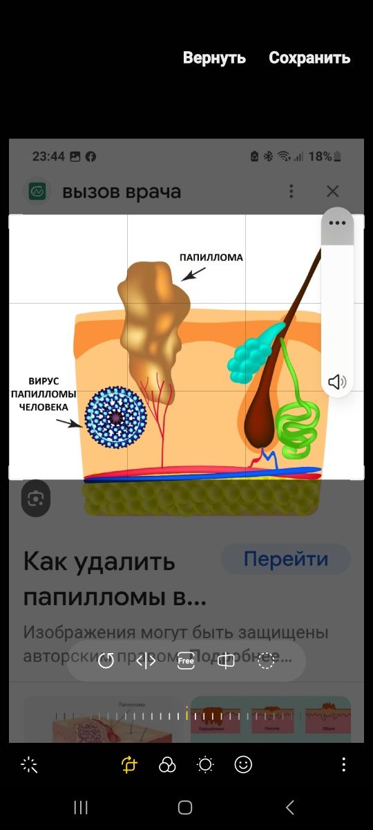 Удаление папиломы