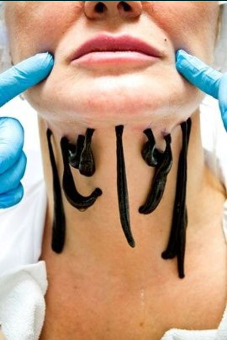 Лечение пиявками гирудотерапия . Выезд на дом по городу и в  пригород