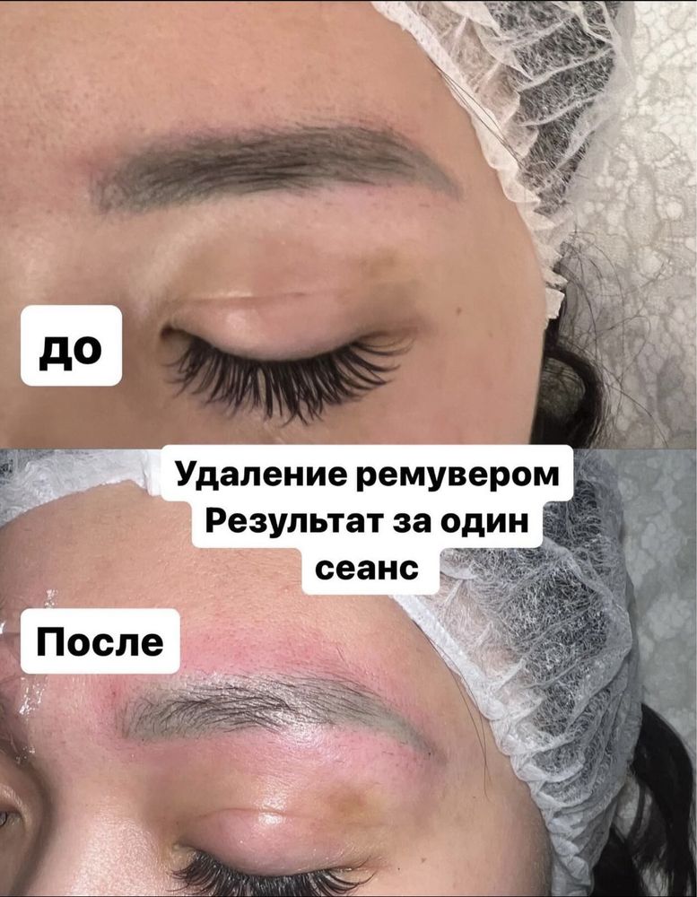 Удаление татуажа бровей и татуировок ремувером